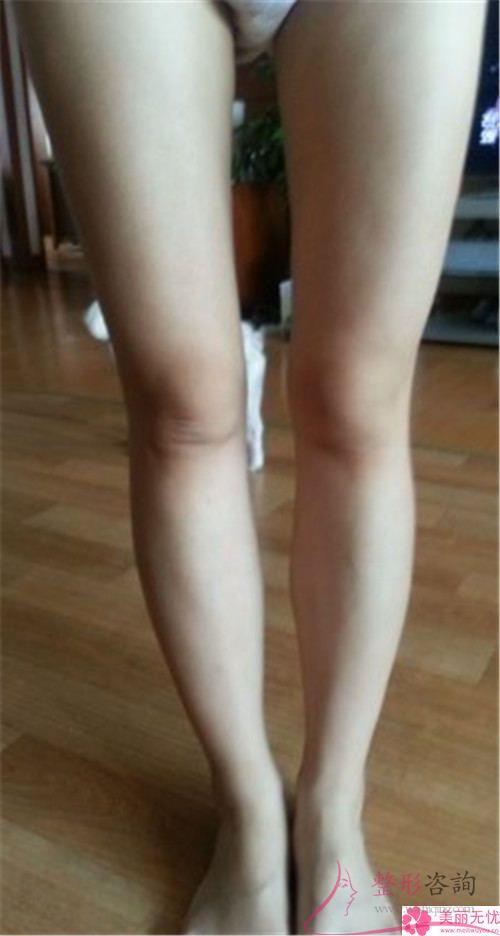 自体脂肪<a href=http://www.mx185.com/listinfo-677-0.html target=_blank class=infotextkey>丰臀</a>术的4个好处