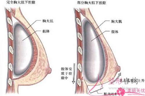 通常多久手术自体脂肪丰胸好