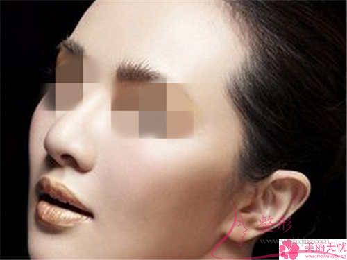 鼻中隔软骨<a href=http://www.mx185.com/listinfo-737-0.html target=_blank class=infotextkey>隆鼻</a>的费用大概得花多少钱