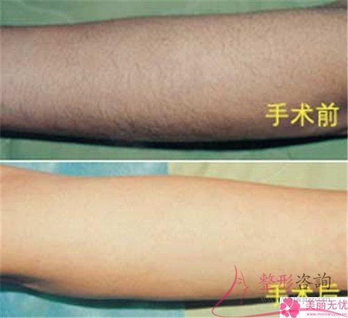 女生小胡子<a href=http://www.mx185.com/listinfo-670-0.html target=_blank class=infotextkey>脱毛</a>选冰点有哪些优点