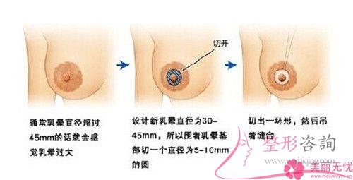 女性实施<a href=http://www.mx185.com/listinfo-625-0.html target=_blank class=infotextkey>乳晕缩小</a>手术的成功率是100%吗