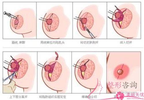 女性实施<a href=http://www.mx185.com/listinfo-625-0.html target=_blank class=infotextkey>乳晕缩小</a>手术的成功率是100%吗