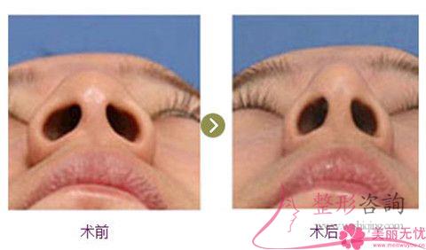 缩小<a href=http://www.mx185.com/listinfo-754-0.html target=_blank class=infotextkey>鼻翼</a>怎么避免瘢痕增生