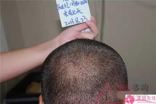 长久性局部脱发的美丽女性可不可以头发植
