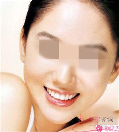 面颊的干纹是否能采取POP蛋白锯齿线埋线<a href=http://www.mx185.com/listinfo-614-0.html target=_blank class=infotextkey>除皱</a>术祛除