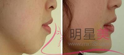 <a href=http://www.mx185.com/listinfo-635-0.html target=_blank class=infotextkey>去颊脂垫</a>术后护理