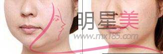 拔牙后面部凹陷
