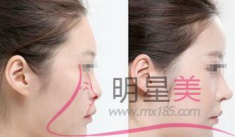 打<a href=http://www.mx185.com/listinfo-731-0.html target=_blank class=infotextkey>玻尿酸</a>什么用