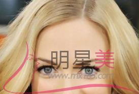 <a href=http://www.mx185.com/listinfo-690-0.html target=_blank class=infotextkey>自体脂肪填充</a>额头肿胀期多久