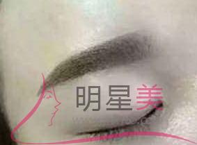 纹眉属于手术吗