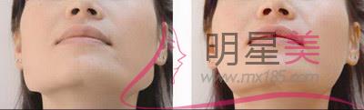 下颌缘<a href=http://www.mx185.com/listinfo-685-0.html target=_blank class=infotextkey>吸脂</a>头套戴多久效果最佳