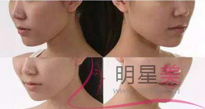 广州下颌缘<a href=http://www.mx185.com/listinfo-685-0.html target=_blank class=infotextkey>吸脂</a>