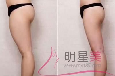 抽腿部脂肪几天可以上班