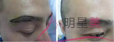 纹眉多久可以怀孕最好