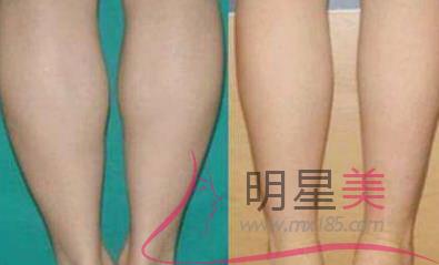 白醋泡姜能减肥吗