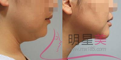 激素脸修复要多久