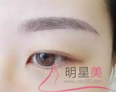 种植眉毛后的效果图