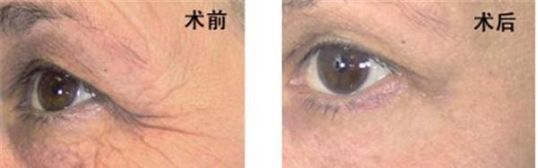 做激光除鱼尾纹不适应人群有哪些