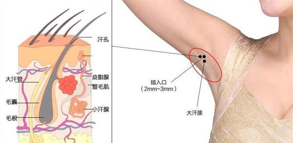 做冷冻法<a href=http://www.mx185.com/listinfo-766-0.html target=_blank class=infotextkey>去腋臭</a>风险有哪些