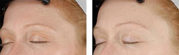 小切口<a href=http://www.mx185.com/listinfo-614-0.html target=_blank class=infotextkey>除皱</a><a href=http://www.mx185.com/listinfo-765-0.html target=_blank class=infotextkey>去抬头纹</a>适应症状是什么？