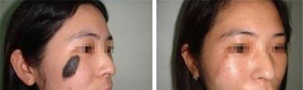 做激光点黑痣价格多少钱