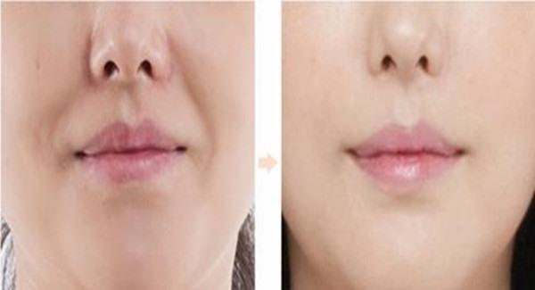 做悬吊<a href=http://www.mx185.com/listinfo-614-0.html target=_blank class=infotextkey>除皱</a><a href=http://www.mx185.com/listinfo-792-0.html target=_blank class=infotextkey>去法令纹</a>手术时间是多久？