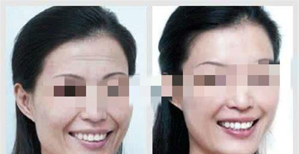 做自体脂肪<a href=http://www.mx185.com/listinfo-765-0.html target=_blank class=infotextkey>去抬头纹</a>费用多少钱