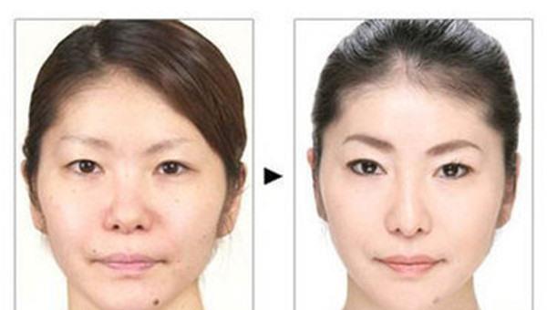 做光子点痣价格