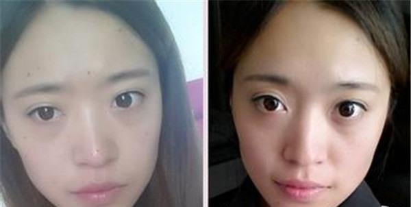 做手术去痣价格