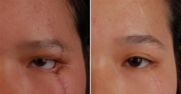 做面部疤痕修复多少钱