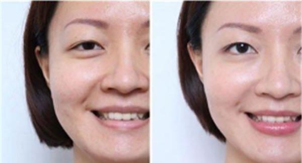 自体脂肪<a href=http://www.mx185.com/listinfo-792-0.html target=_blank class=infotextkey>去法令纹</a>适合哪种人?