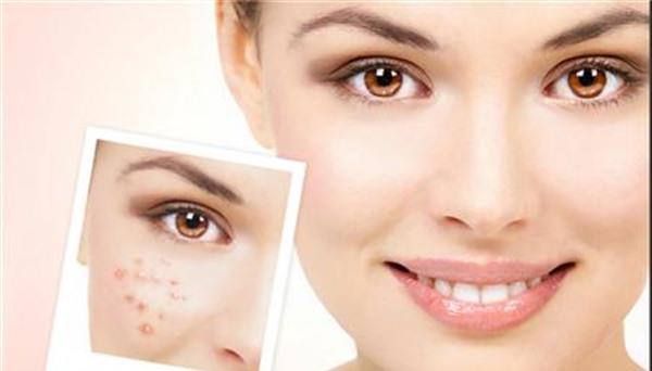 做激光去痘印手术多少钱?