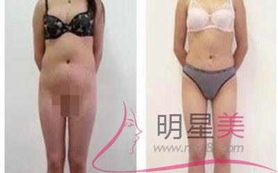 常熟去哪儿溶脂好