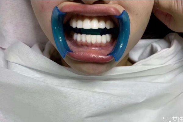 冰瓷美牙有什么危害 冰瓷美牙的副作用