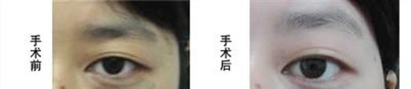 冷冻去除太田痣手术的方法是什么？