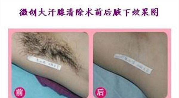 电离子<a href=http://www.mx185.com/listinfo-766-0.html target=_blank class=infotextkey>去腋臭</a>手术的方法是什么？