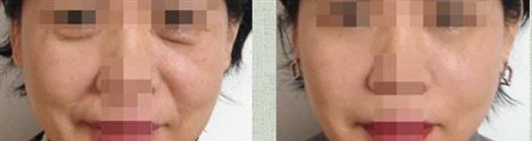 <a href=http://www.mx185.com/listinfo-613-0.html target=_blank class=infotextkey>射频</a>紧肤麻醉方式是什么?