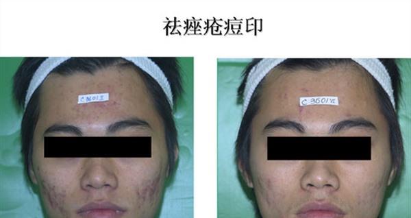 红蓝光祛痘麻醉方式是什么？