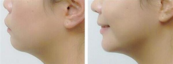 自体脂肪除颈纹适应症状是什么?