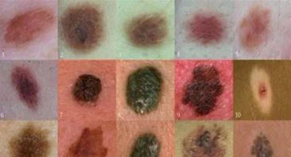 做<a href=http://www.mx185.com/listinfo-788-0.html target=_blank class=infotextkey>去黑痣</a>副作用