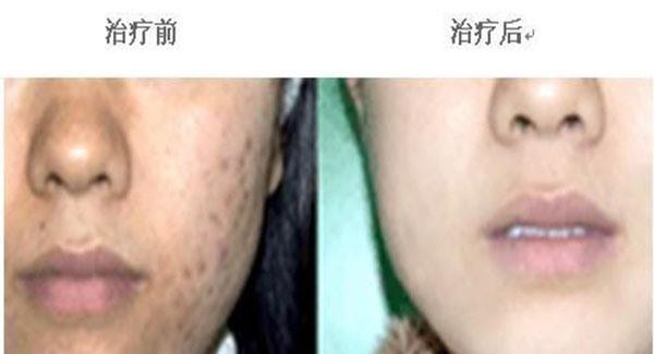 做冷冻治疗<a href=http://www.mx185.com/listinfo-797-0.html target=_blank class=infotextkey>去痘疤</a>副作用