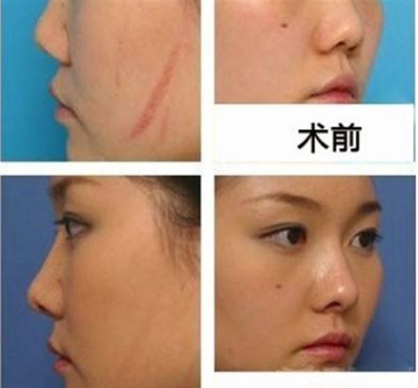 疤痕增生修复效果好不好?