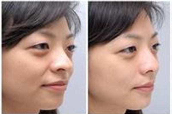 微晶磨削<a href=http://www.mx185.com/listinfo-792-0.html target=_blank class=infotextkey>去法令纹</a>不适合哪种人？