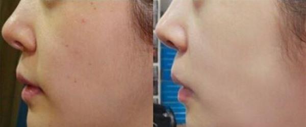 水光娃娃手术注意事项是什么?