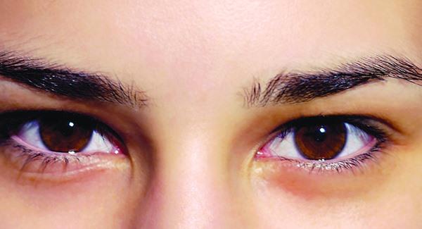 激光去除抬头纹费用