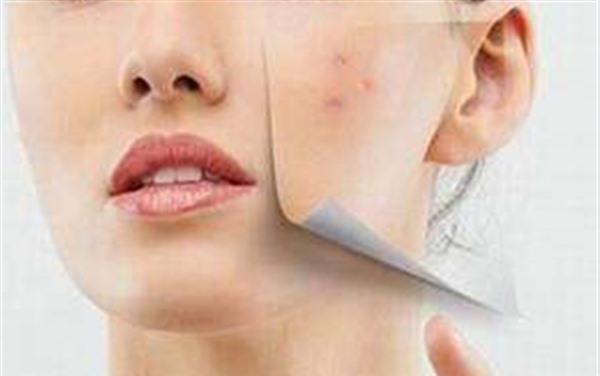 兰州治疗青春痘医院哪家好