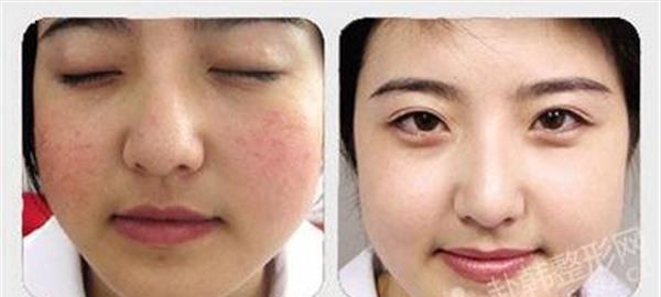 做<a href=http://www.mx185.com/listinfo-772-0.html target=_blank class=infotextkey>去红血丝</a>失败修复有副作用吗