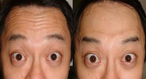 做内窥镜<a href=http://www.mx185.com/listinfo-614-0.html target=_blank class=infotextkey>除皱</a><a href=http://www.mx185.com/listinfo-765-0.html target=_blank class=infotextkey>去抬头纹</a>副作用