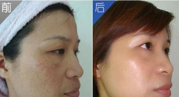 做<a href=http://www.mx185.com/listinfo-786-0.html target=_blank class=infotextkey>去黄褐斑</a>副作用