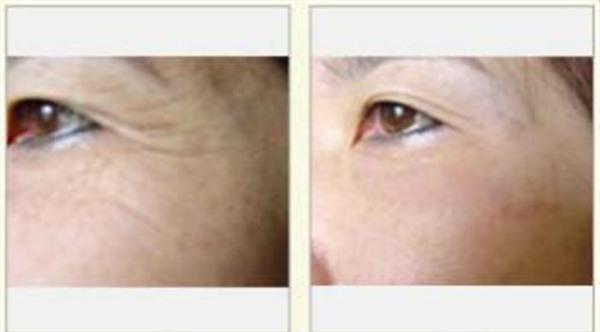 小切口<a href=http://www.mx185.com/listinfo-614-0.html target=_blank class=infotextkey>除皱</a><a href=http://www.mx185.com/listinfo-780-0.html target=_blank class=infotextkey>去鱼尾纹</a>治疗方式是什么?